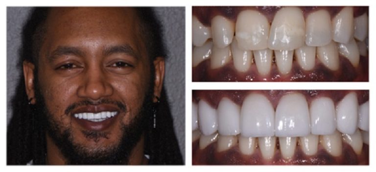 Veneers for a celebrity smile makeover