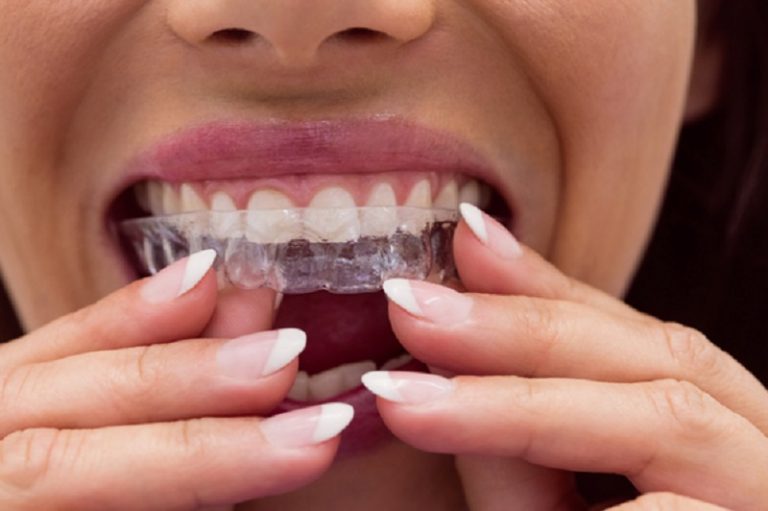 Invisalign Sydney for beautiful, straight teeth at any age