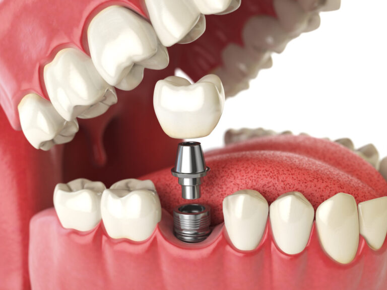 Possible Dental Implant Complications