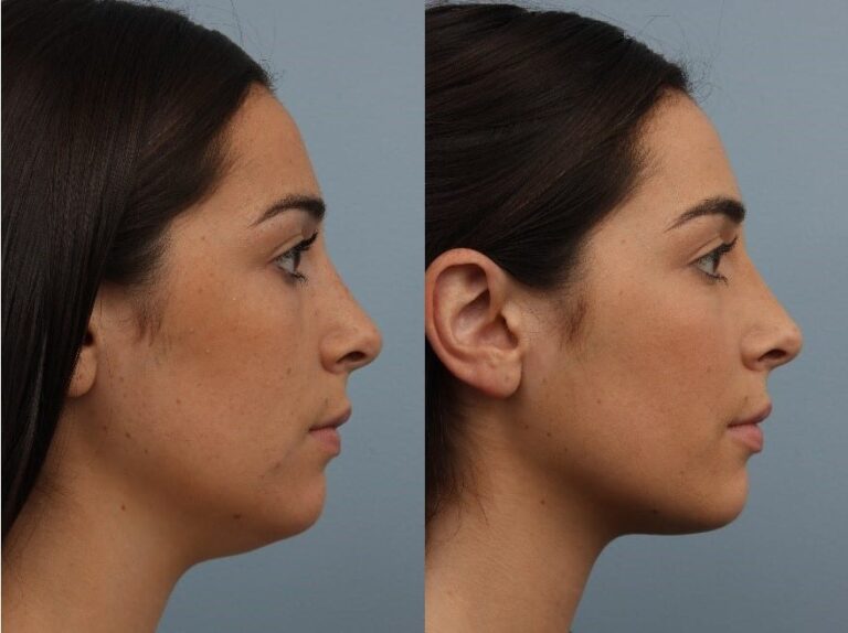 What Non-Invasive Treatments Work Best for Double Chin Removal?