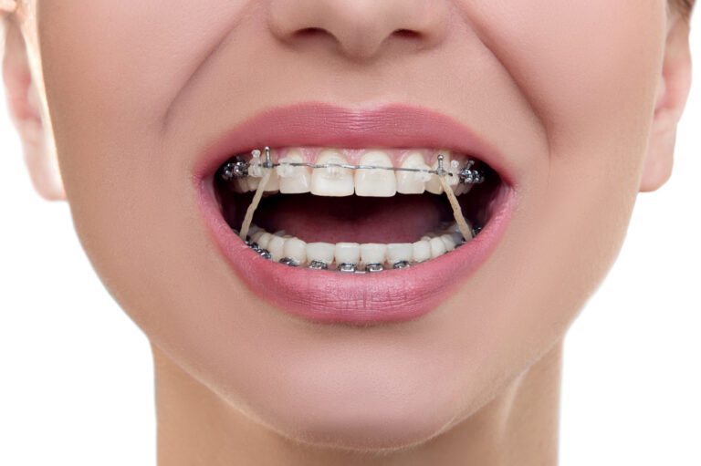What Purpose Do Elastics (Rubber Bands) Have for Braces?