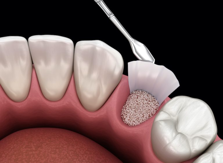 Tips to Prepare Yourself Before Bone Grafting