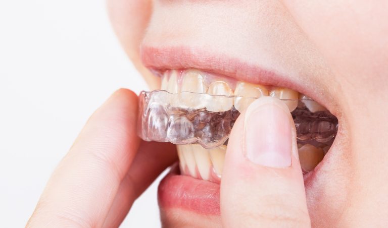 Wearing a Dental Night Guard —Things to Know
