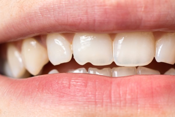 Should You Go to the Dentist if a Molar Tooth Breaks?