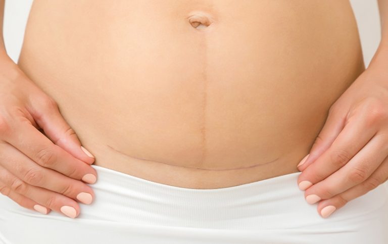 Navigating The Post-C-Section Healing Journey: Understanding The Recovery Timeline