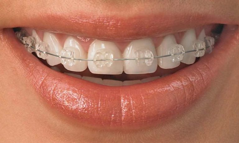 The Comprehensive Guide to Lingual Braces: Aesthetic Orthodontics lingual braces