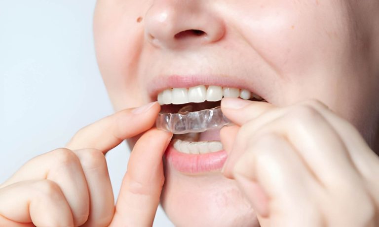 Why Invisalign is a Popular Choice for Straightening Teeth